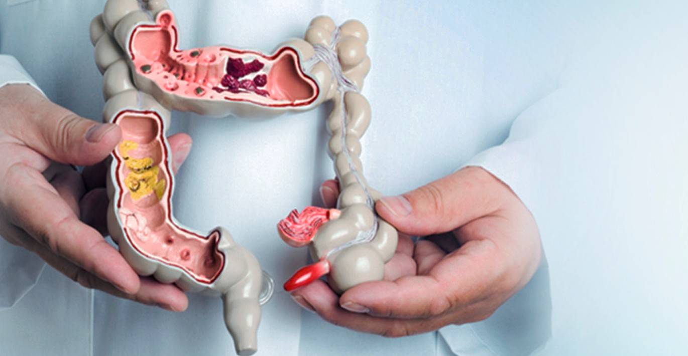Медична модель товстого кишківника в руках лікаря — ілюстрація захворювань кишечника та травної системи.