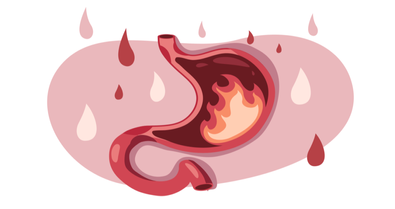 Схематичне зображення запалення шлунка та підвищеної кислотності — причина болю і печії