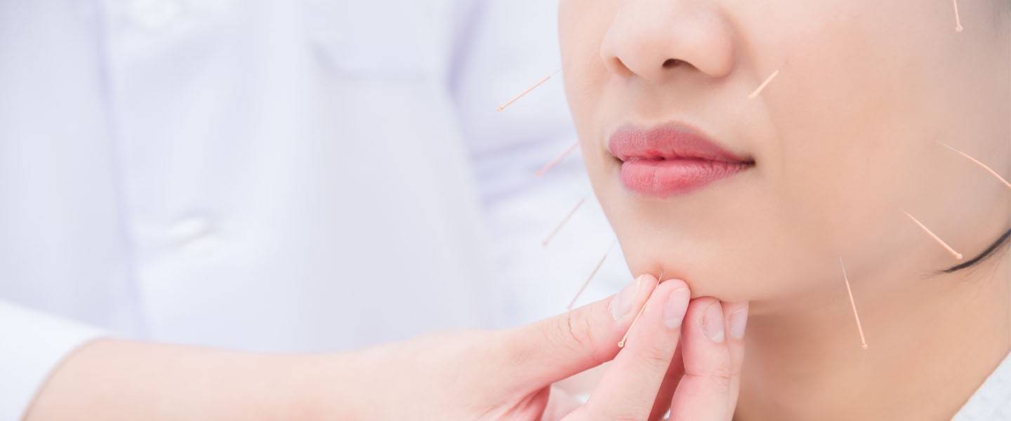 Акупунктурне лікування невриту лицьового нерва — голковколювання в ділянці обличчя