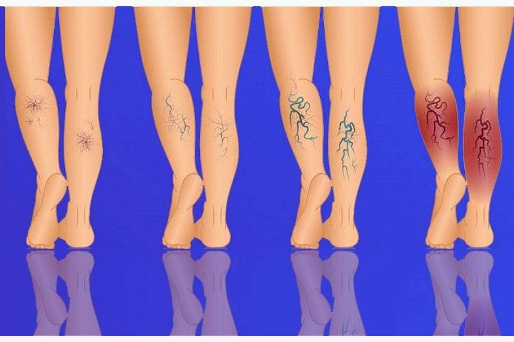 Стадії варикозного розширення вен на ногах — від початкових судинних зірочок до вираженого варикозу