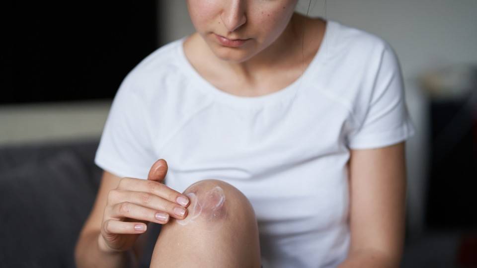 Забій коліна після сильного удару – нанесення крему для зменшення набряку та болю.